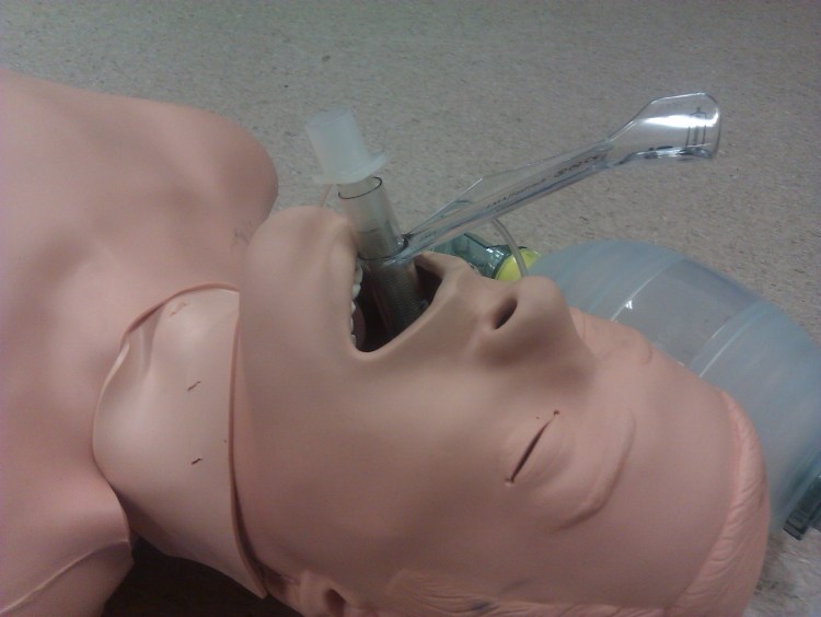 blind intubation via ILMA