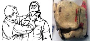 This is not cricoid pressure. Courtesy of Richard Levitan