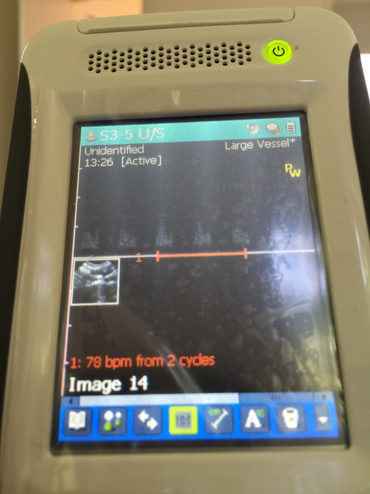 PWD measurement over femoral artery with beat per minute calculation